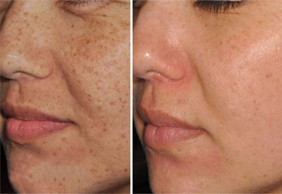 Laser Acne Removal St Petersburg Florida